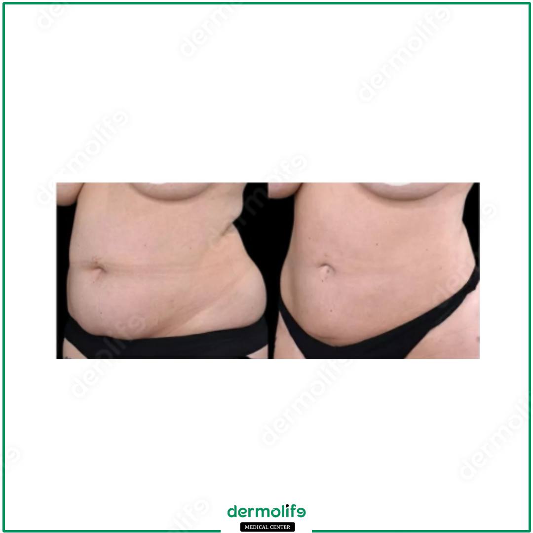 abdominoplasty aesthetic clinic italy 