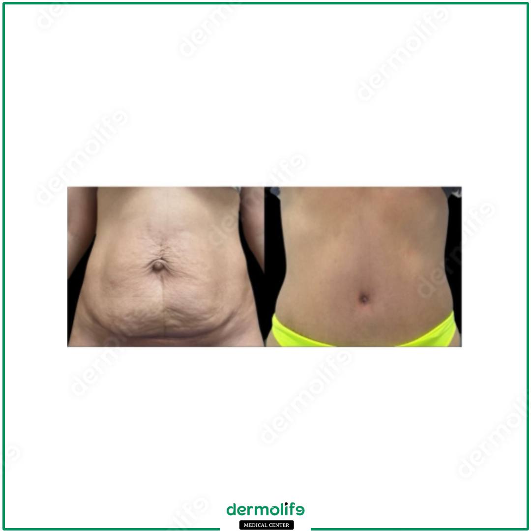 abdominoplasty aesthetic clinic italy 