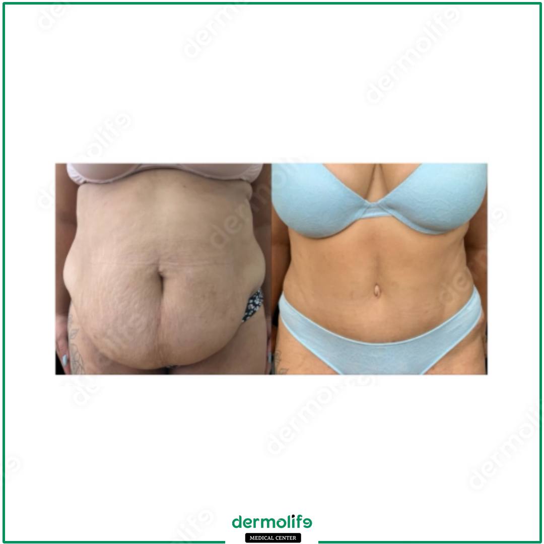 abdominoplasty aesthetic clinic italy 