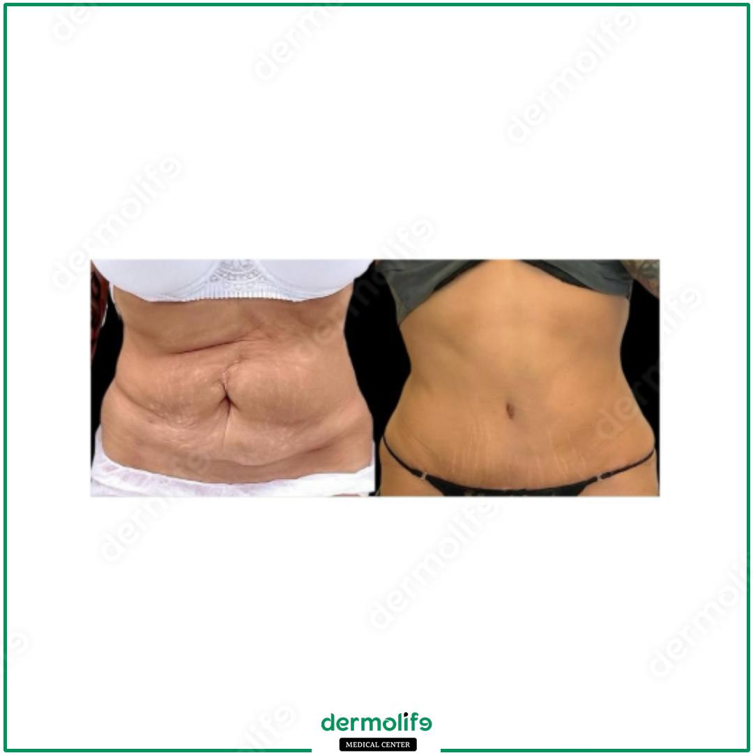 abdominoplasty aesthetic clinic italy 