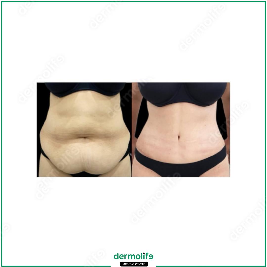 abdominoplasty aesthetic clinic italy 