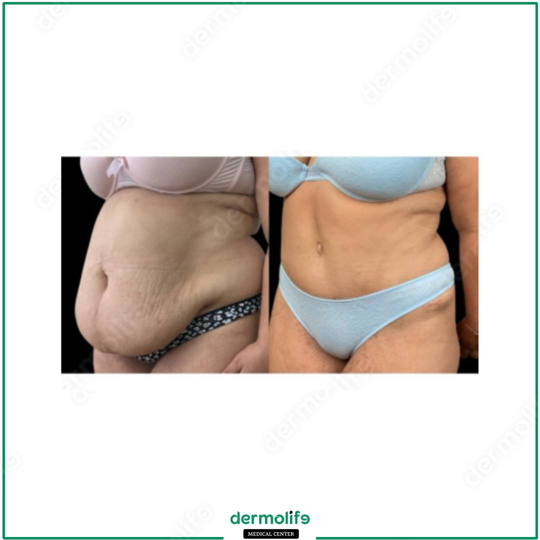 abdominoplasty aesthetic clinic italy 