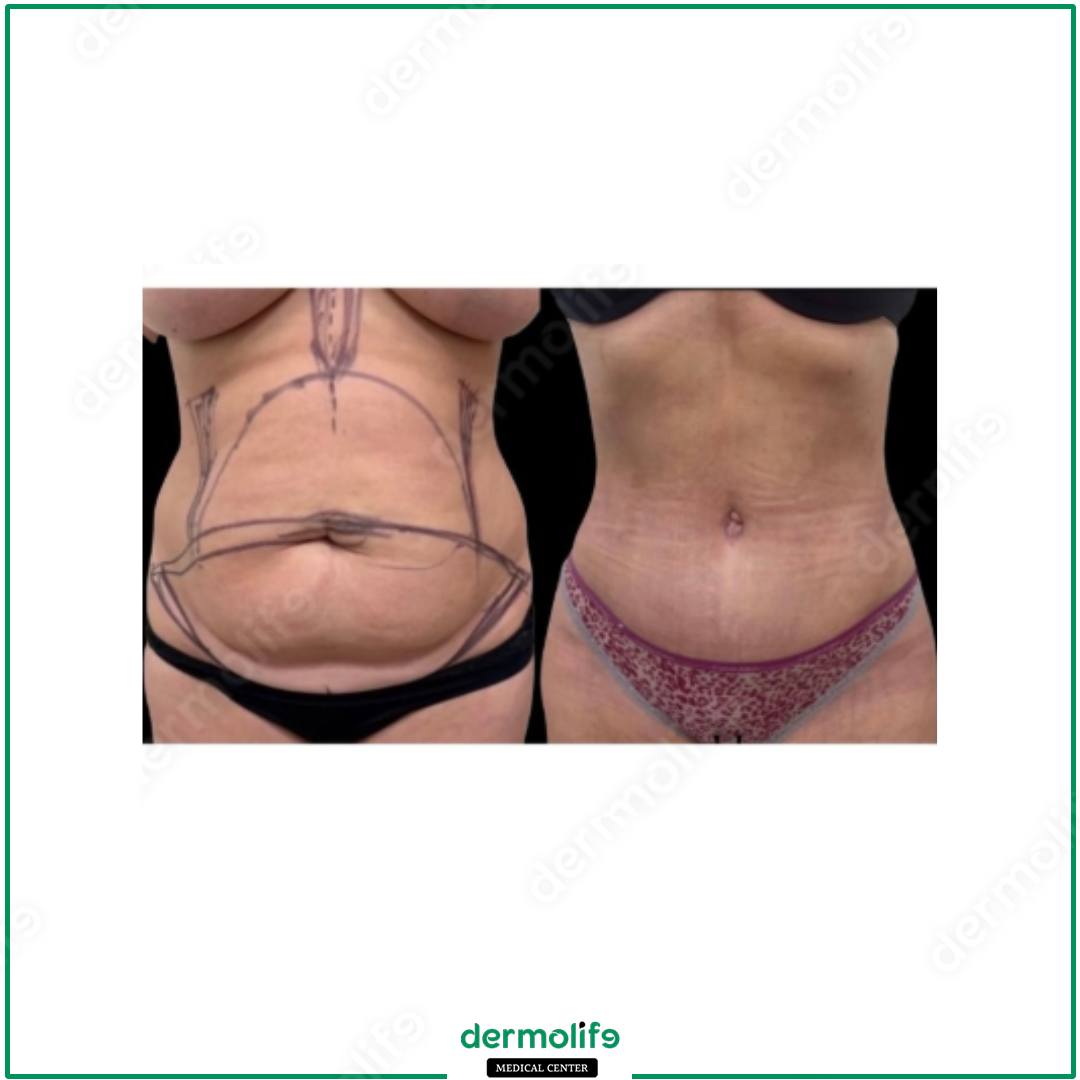 abdominoplasty aesthetic clinic italy 