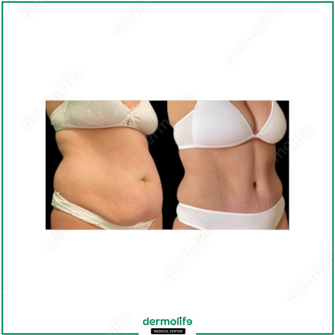 abdominoplasty aesthetic clinic italy 