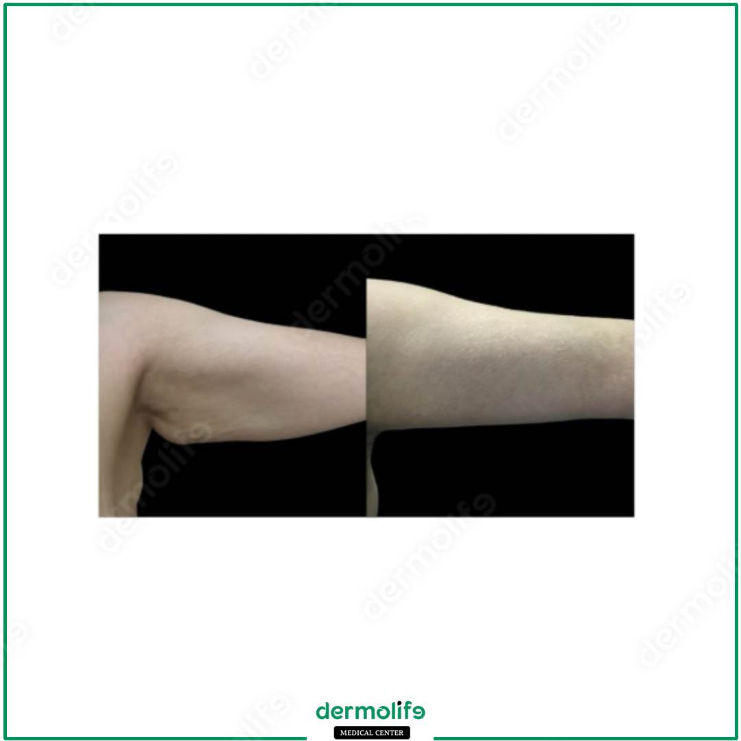 braccia clinica estetica italy 