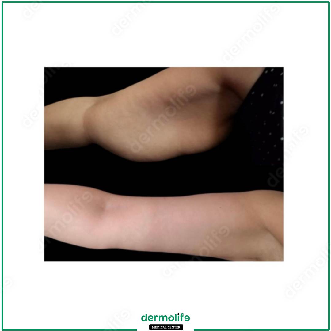 braccia clinica estetica italy 