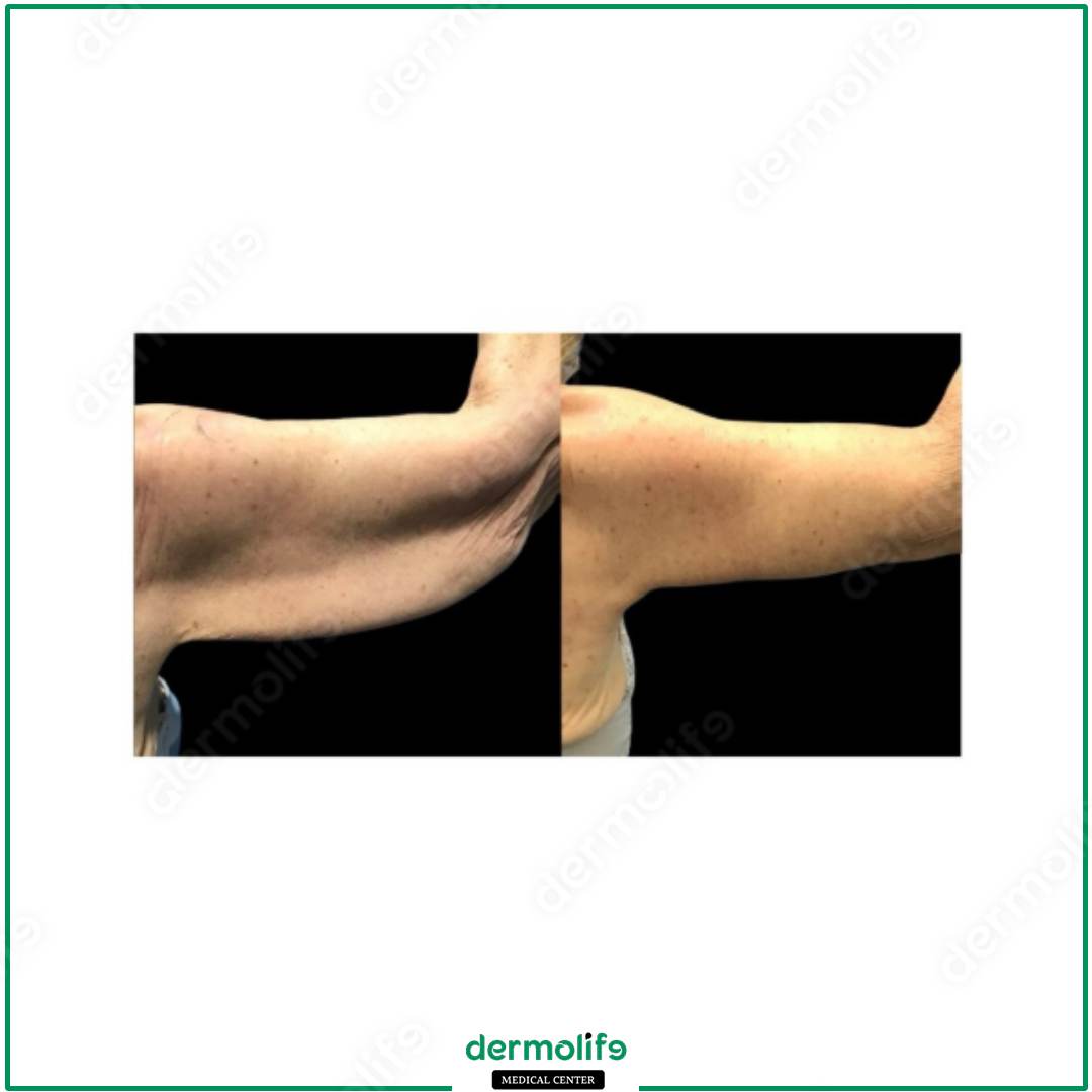 braccia clinica estetica italy 