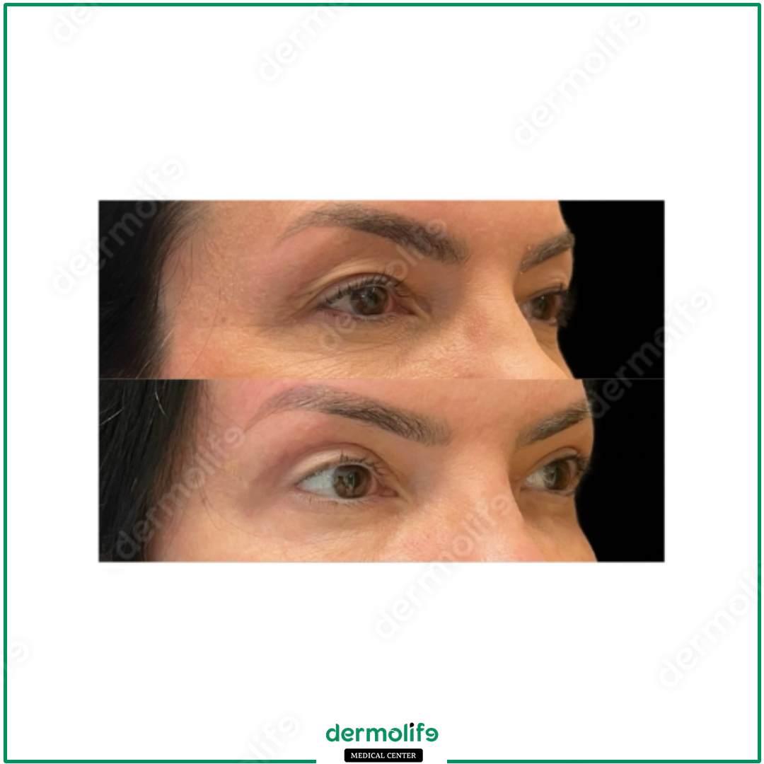 blepharoplasty aesthetic clinic italy 