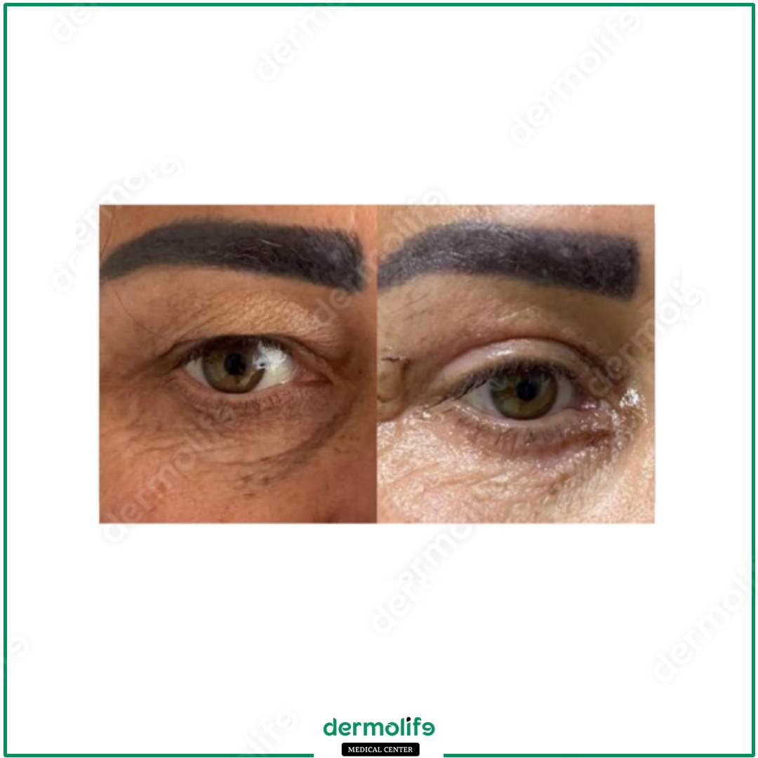 blepharoplasty aesthetic clinic italy 
