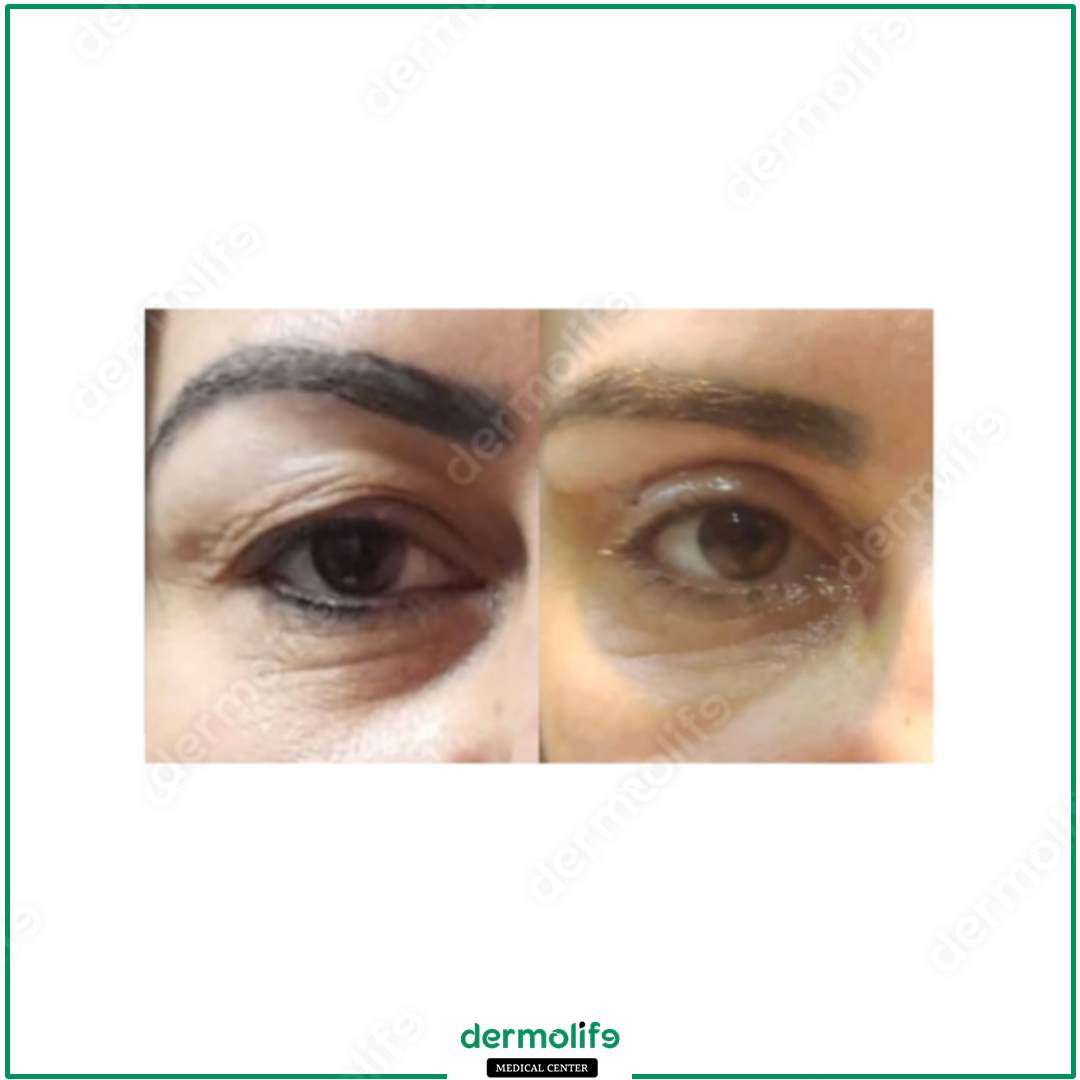 blepharoplasty aesthetic clinic italy 