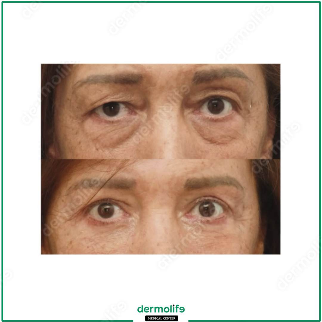 blepharoplasty aesthetic clinic italy 