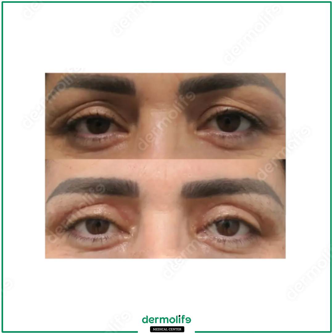 blepharoplasty aesthetic clinic italy 