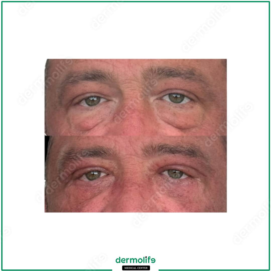 blepharoplasty aesthetic clinic italy 