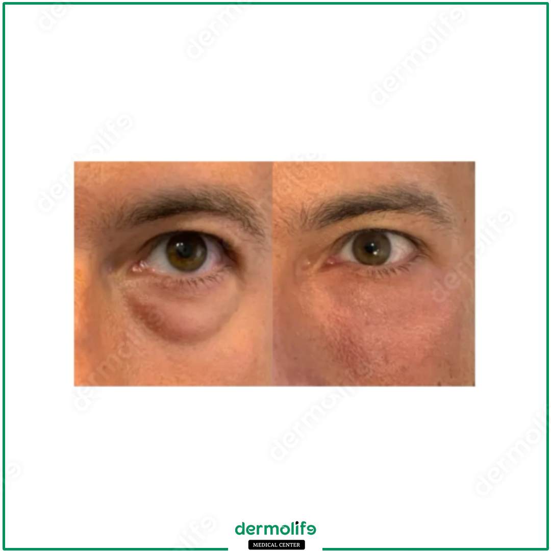 blepharoplasty aesthetic clinic italy 