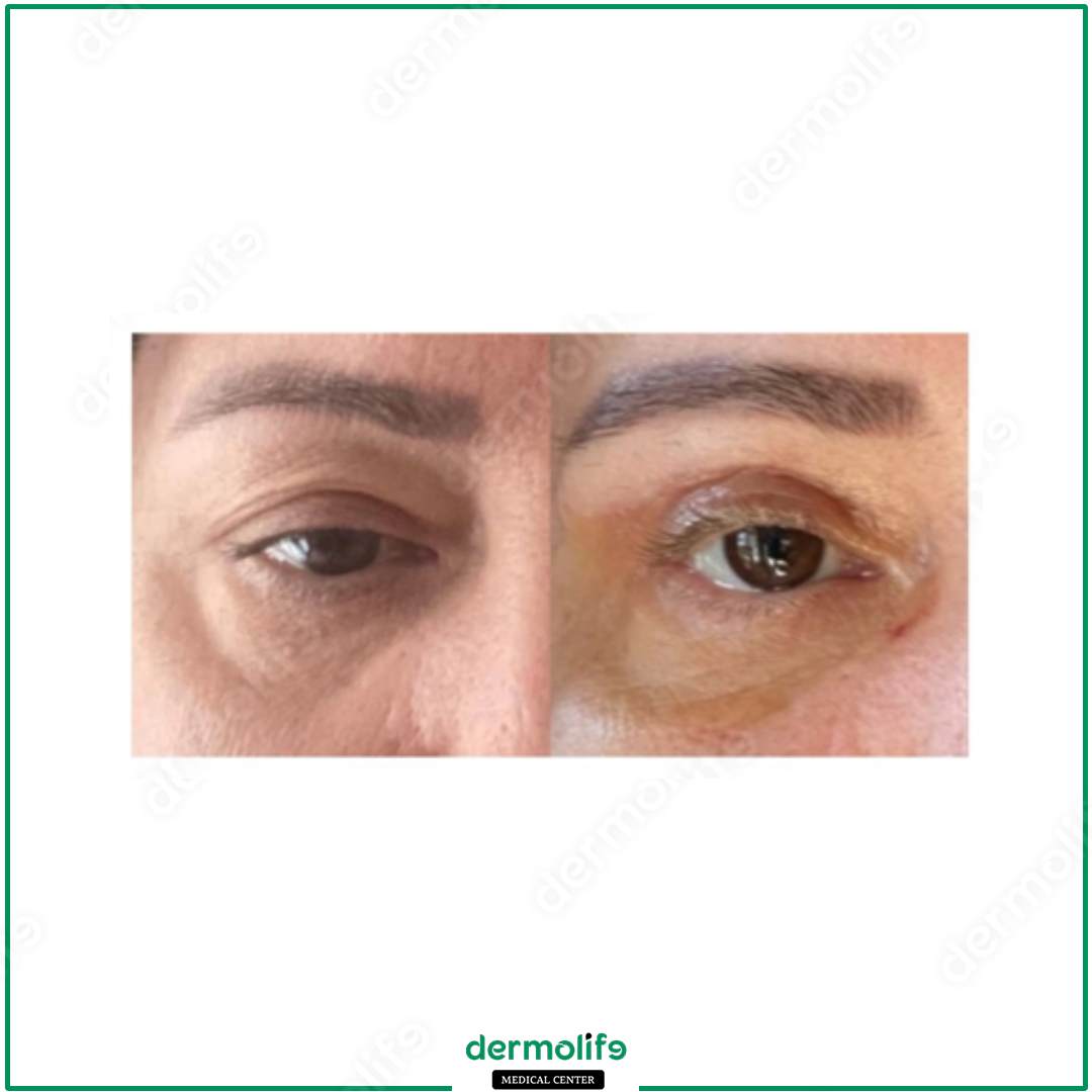 blepharoplasty aesthetic clinic italy 