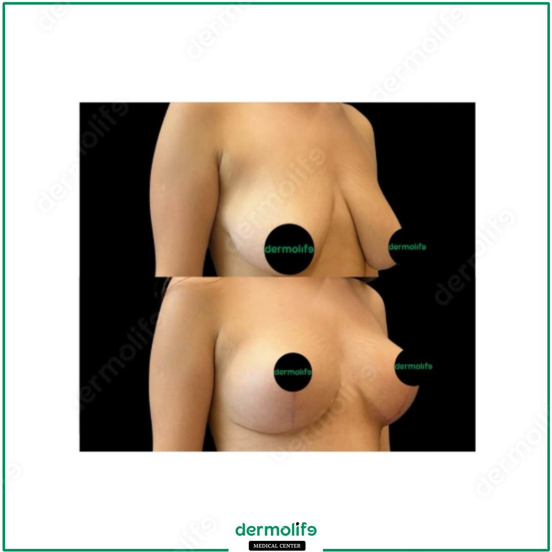 lifting del seno clinica estetica italy 