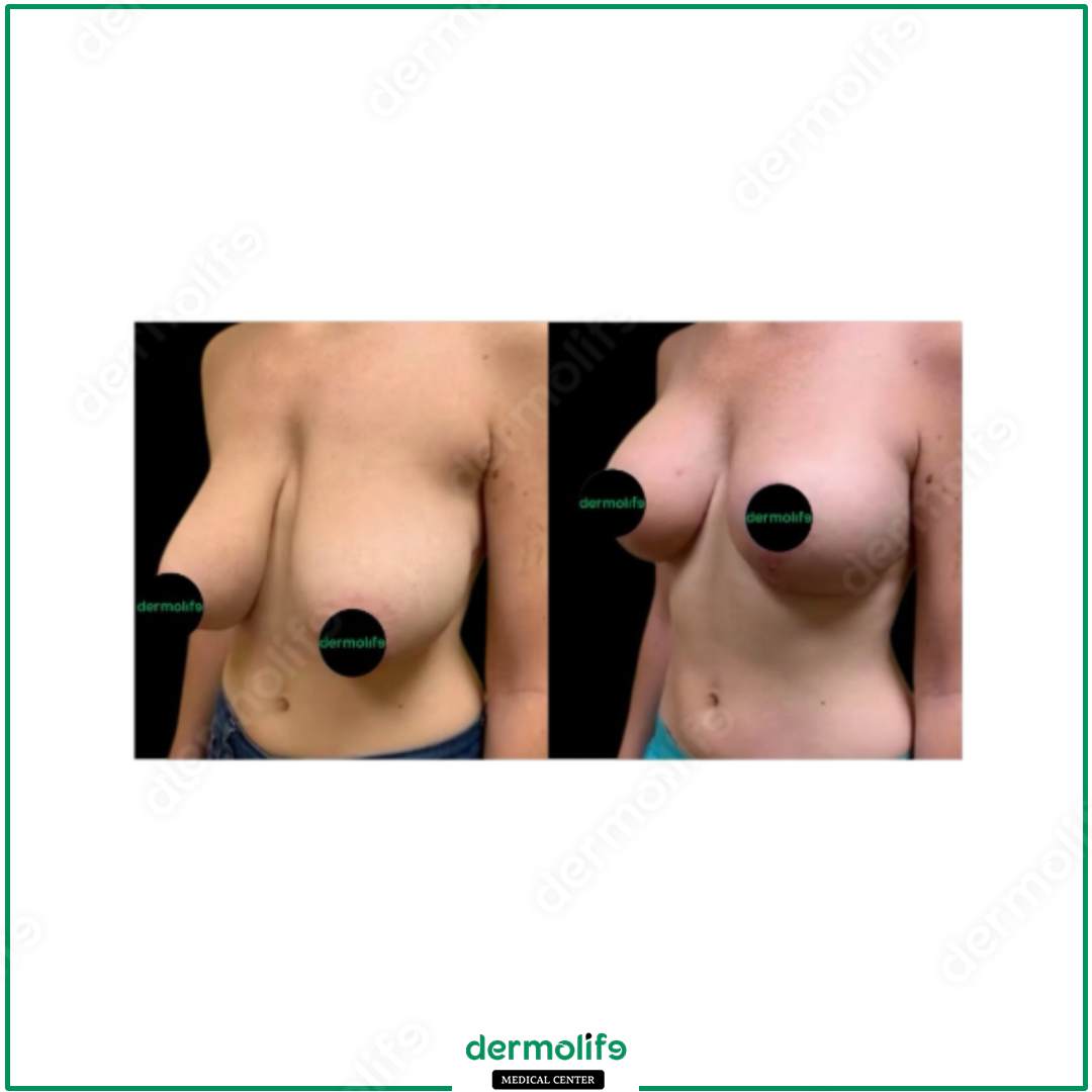 lifting del seno clinica estetica italy 