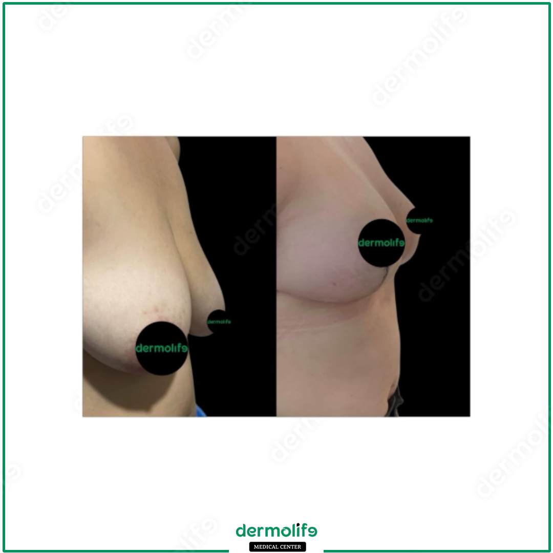 lifting del seno clinica estetica italy 