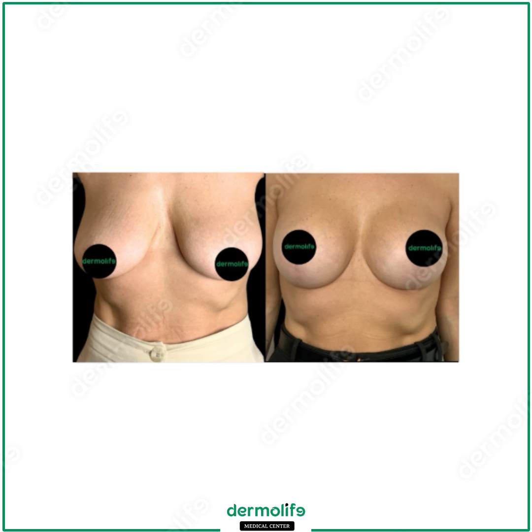 lifting del seno clinica estetica italy 