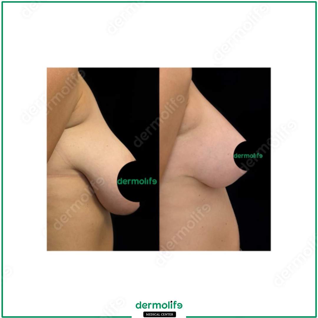 breast reduction aesthetic clinic italy 