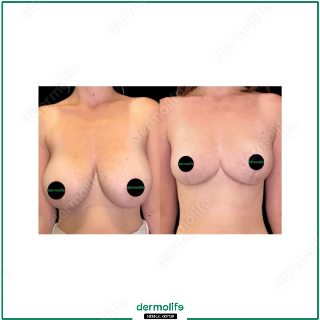 breast reduction aesthetic clinic italy 
