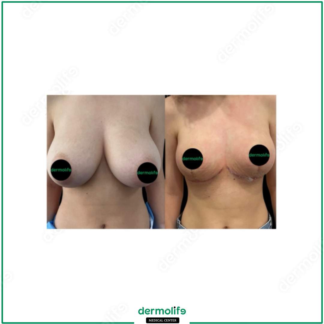 breast reduction aesthetic clinic italy 