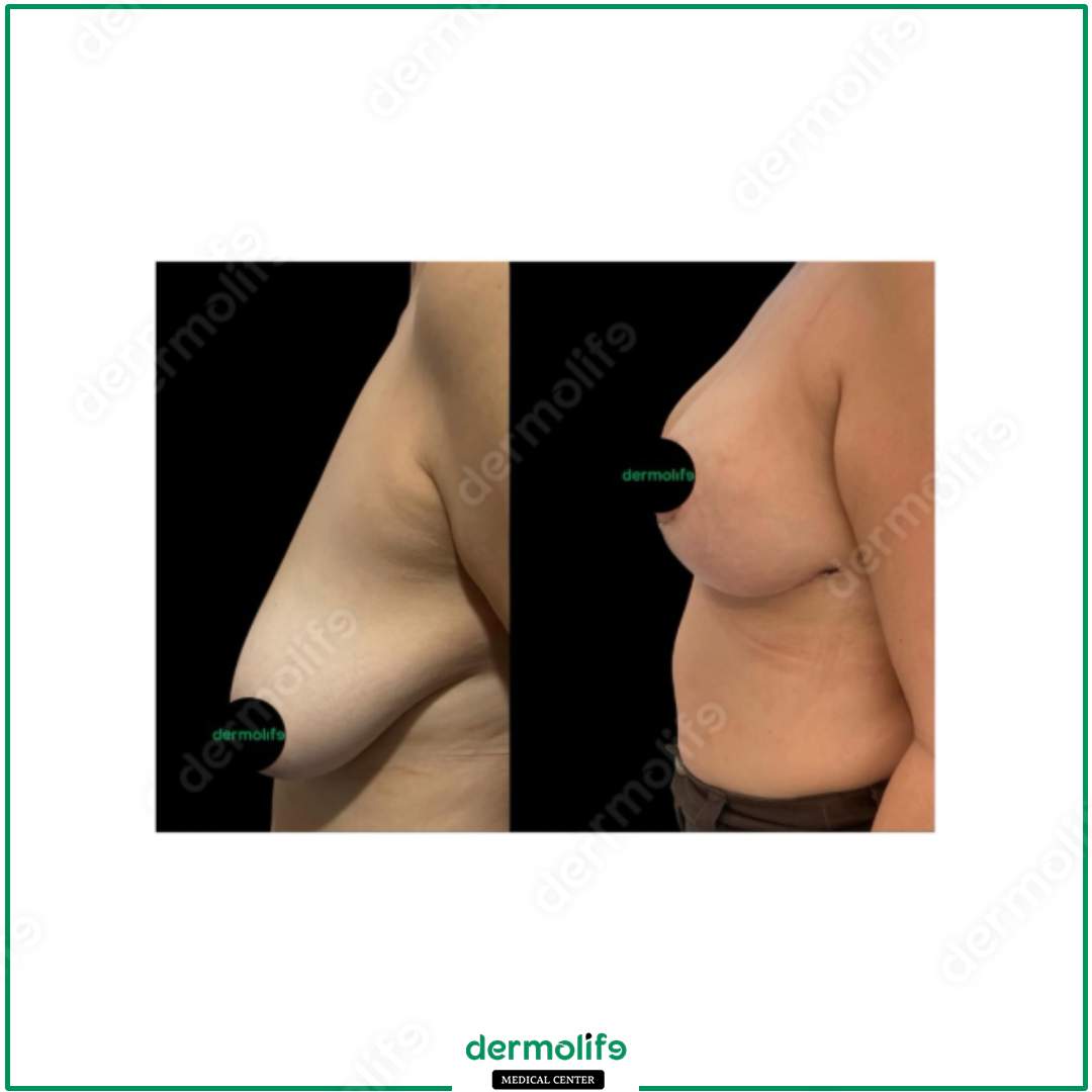 breast reduction aesthetic clinic italy 