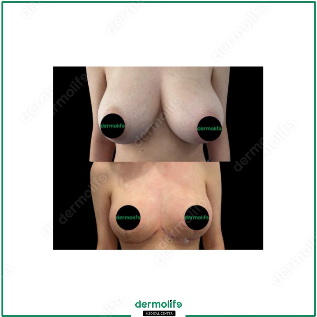 breast reduction aesthetic clinic italy 