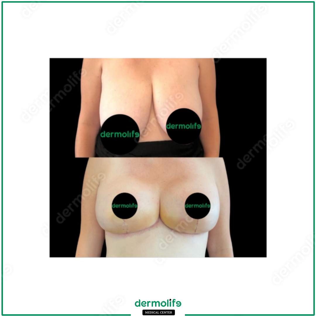 breast reduction aesthetic clinic italy 