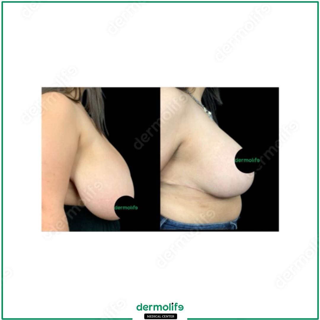 breast reduction aesthetic clinic italy 