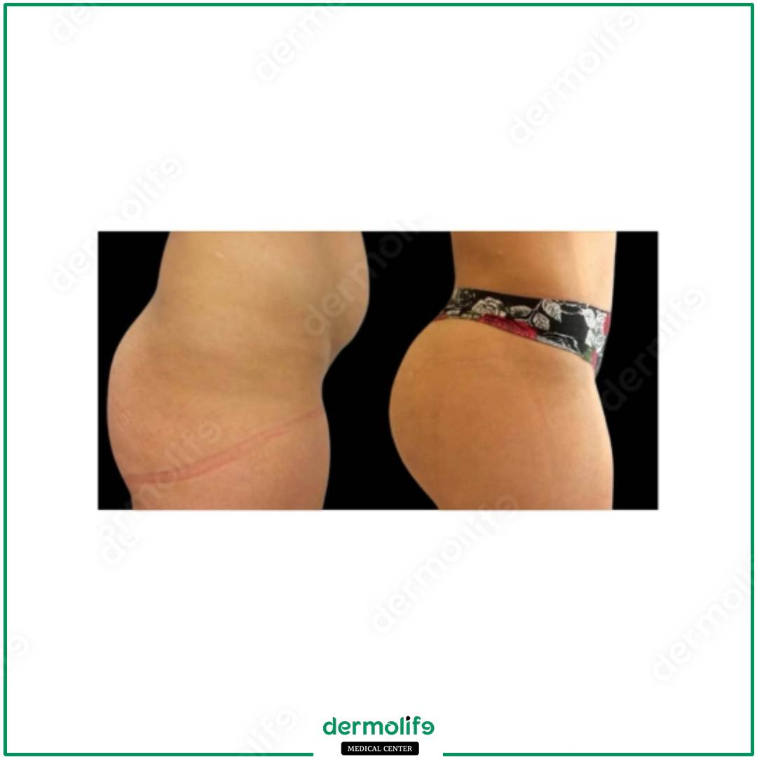 gluteoplastica clinica estetica italy 