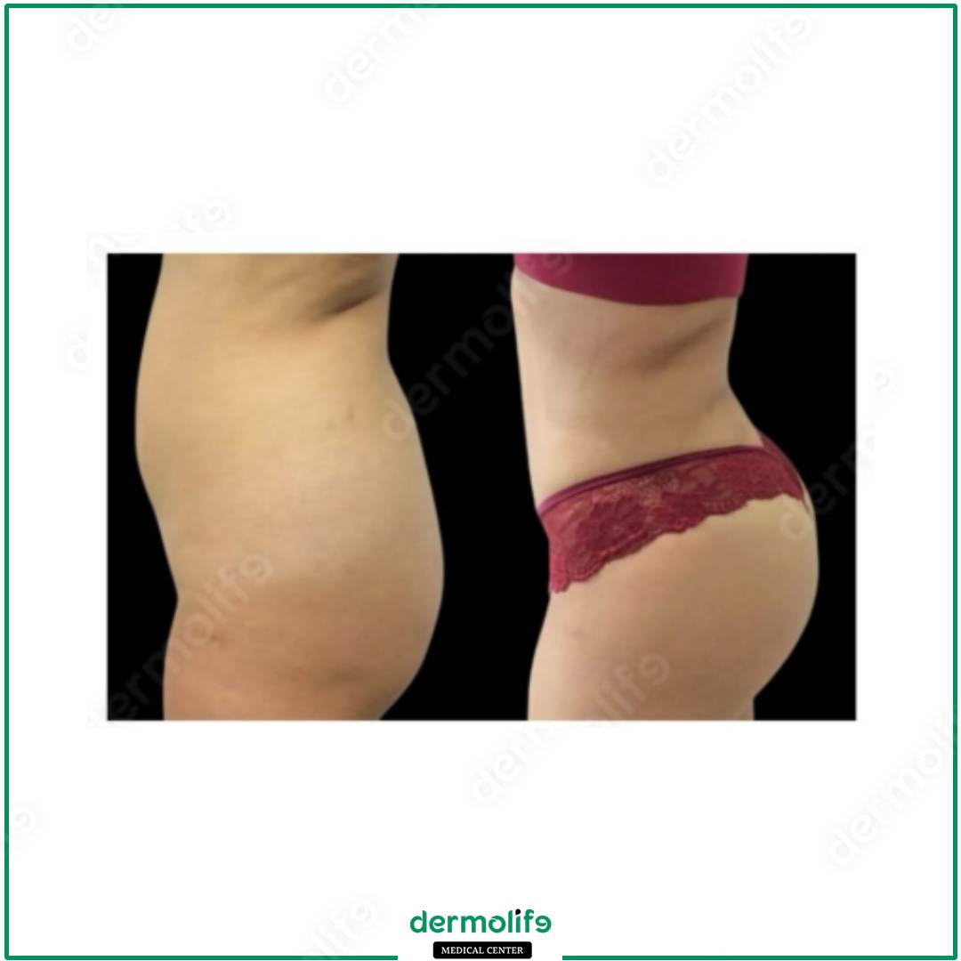 gluteoplastica clinica estetica italy 