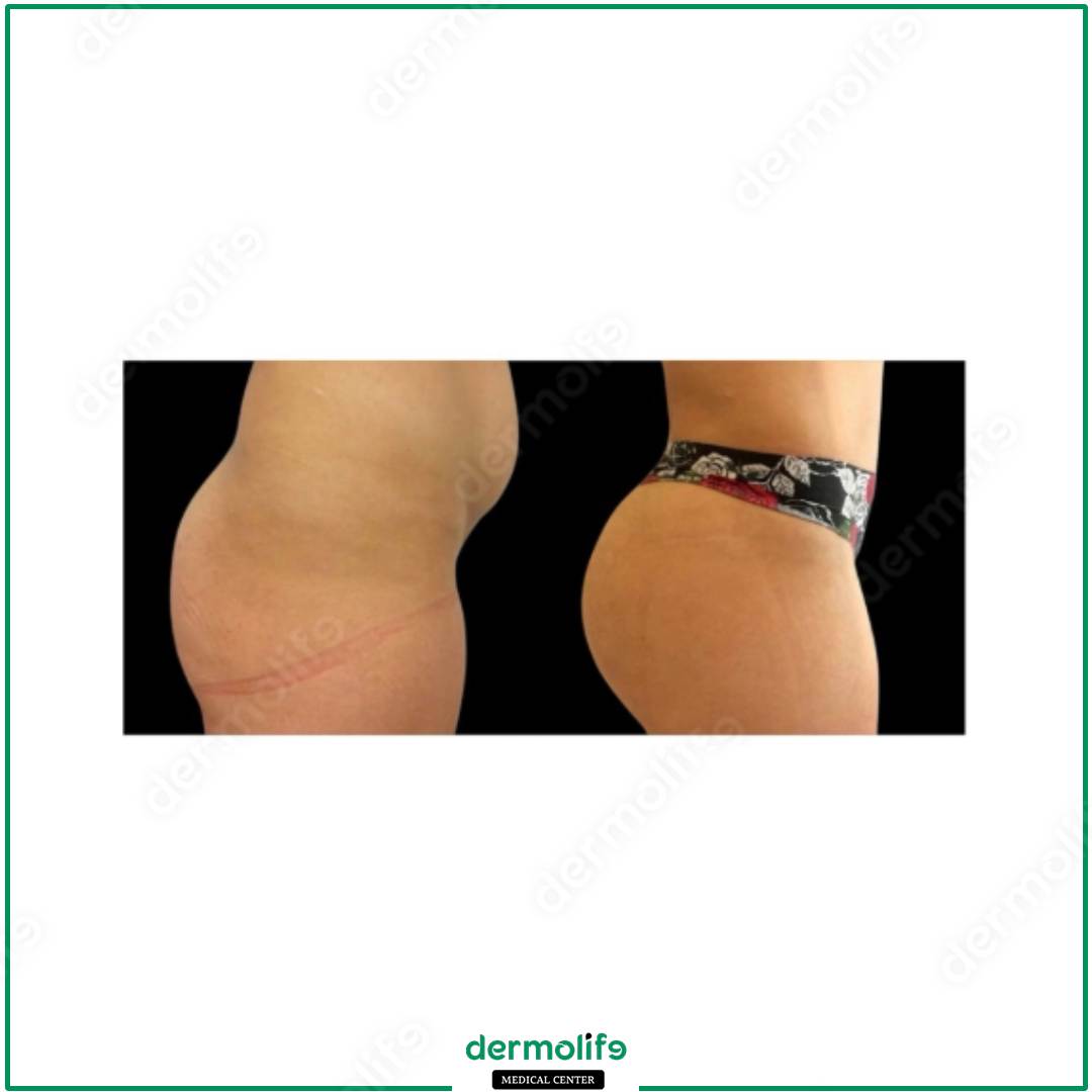gluteoplastica clinica estetica italy 