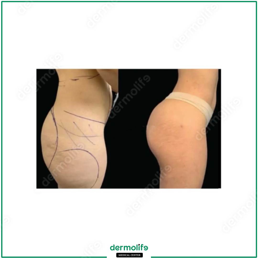 gluteoplastica clinica estetica italy 