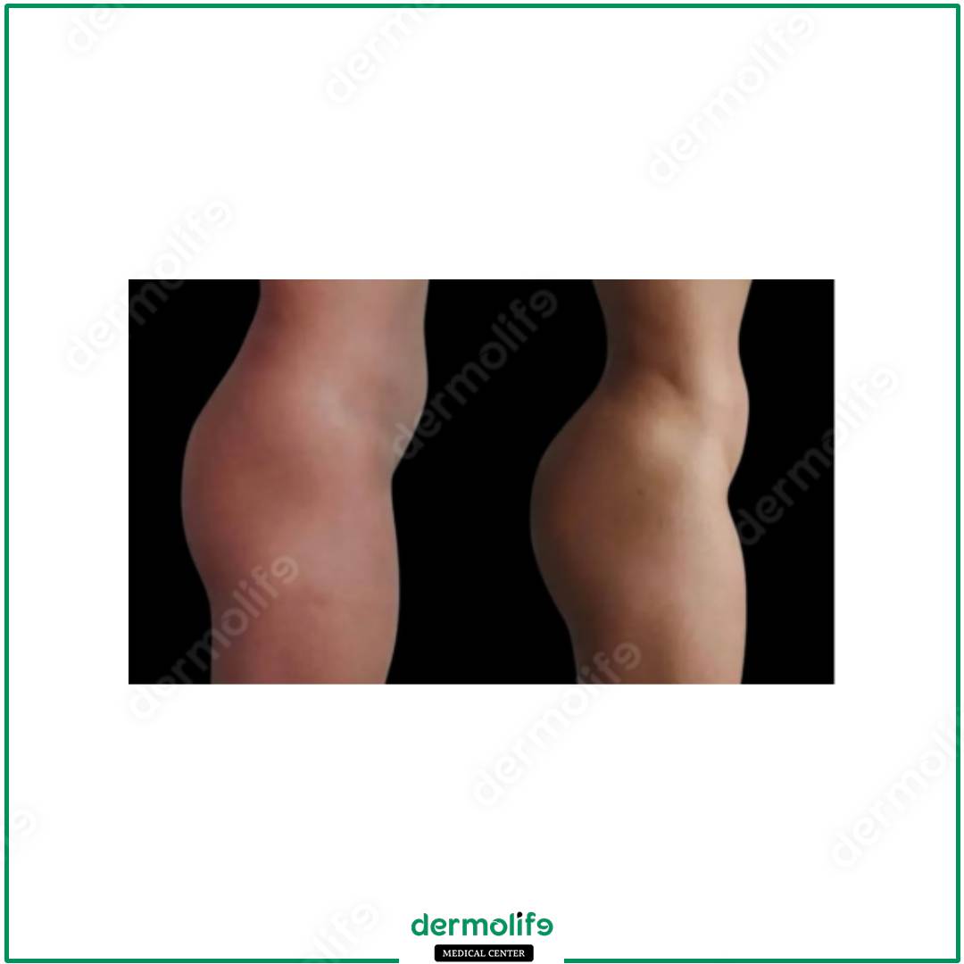 gluteoplastica clinica estetica italy 