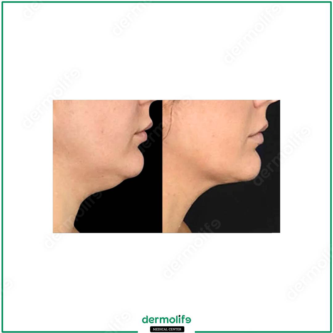 chin reshaping aesthetic clinic italy 