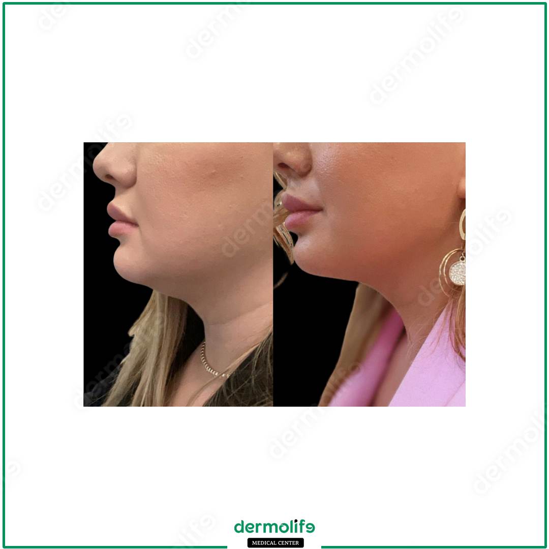 chin reshaping aesthetic clinic italy 