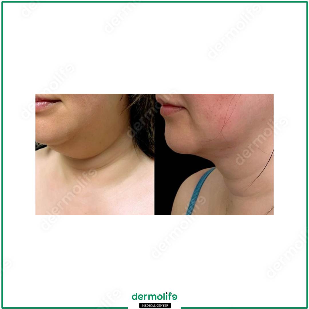 chin reshaping aesthetic clinic italy 