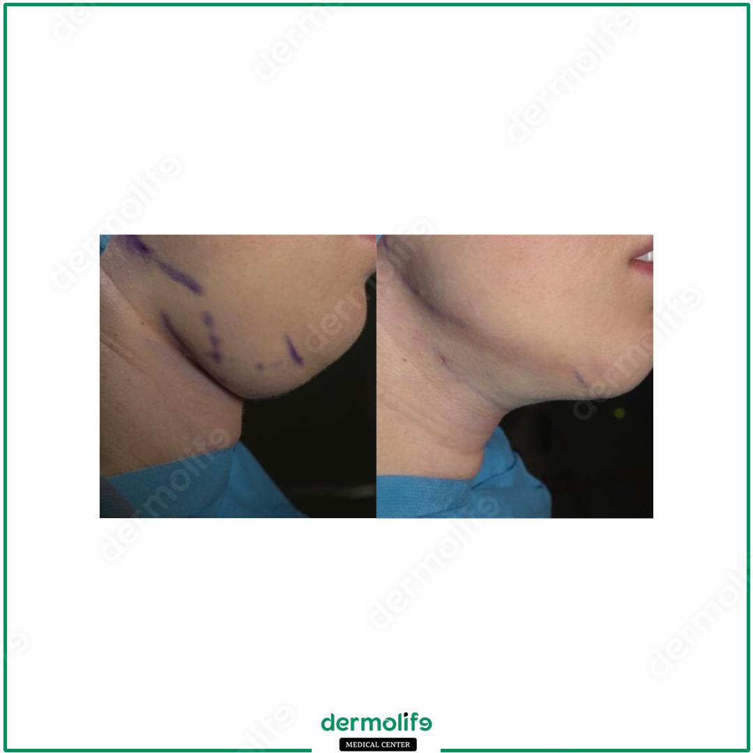 chin reshaping aesthetic clinic italy 
