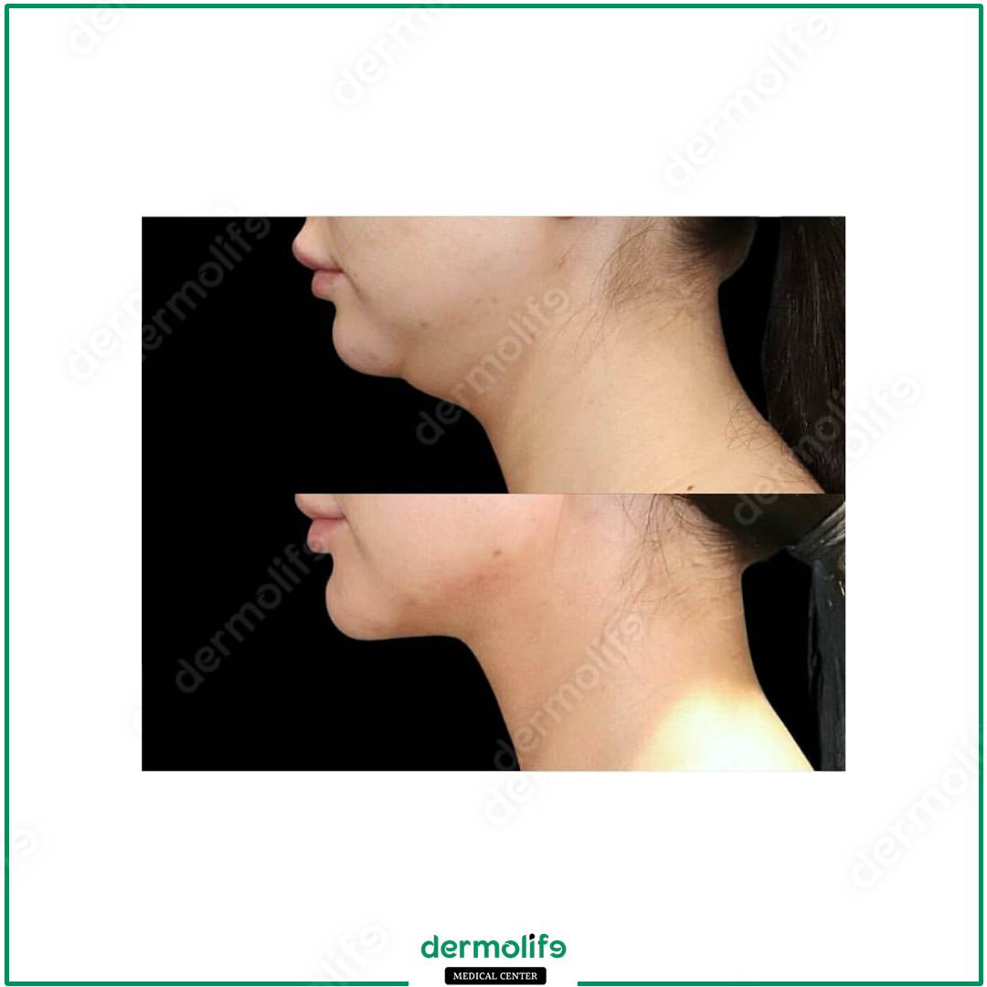 chin reshaping aesthetic clinic italy 