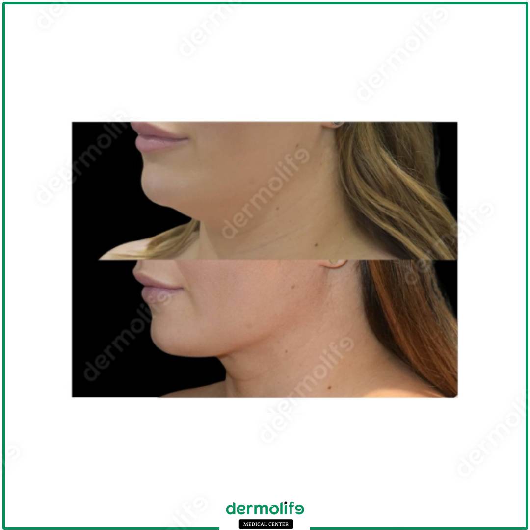 chin reshaping aesthetic clinic italy 