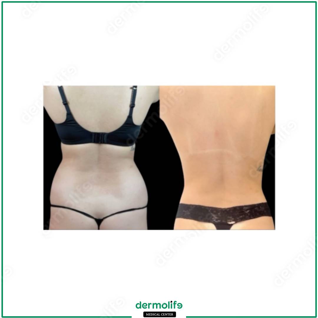 liposuction aesthetic clinic italy 
