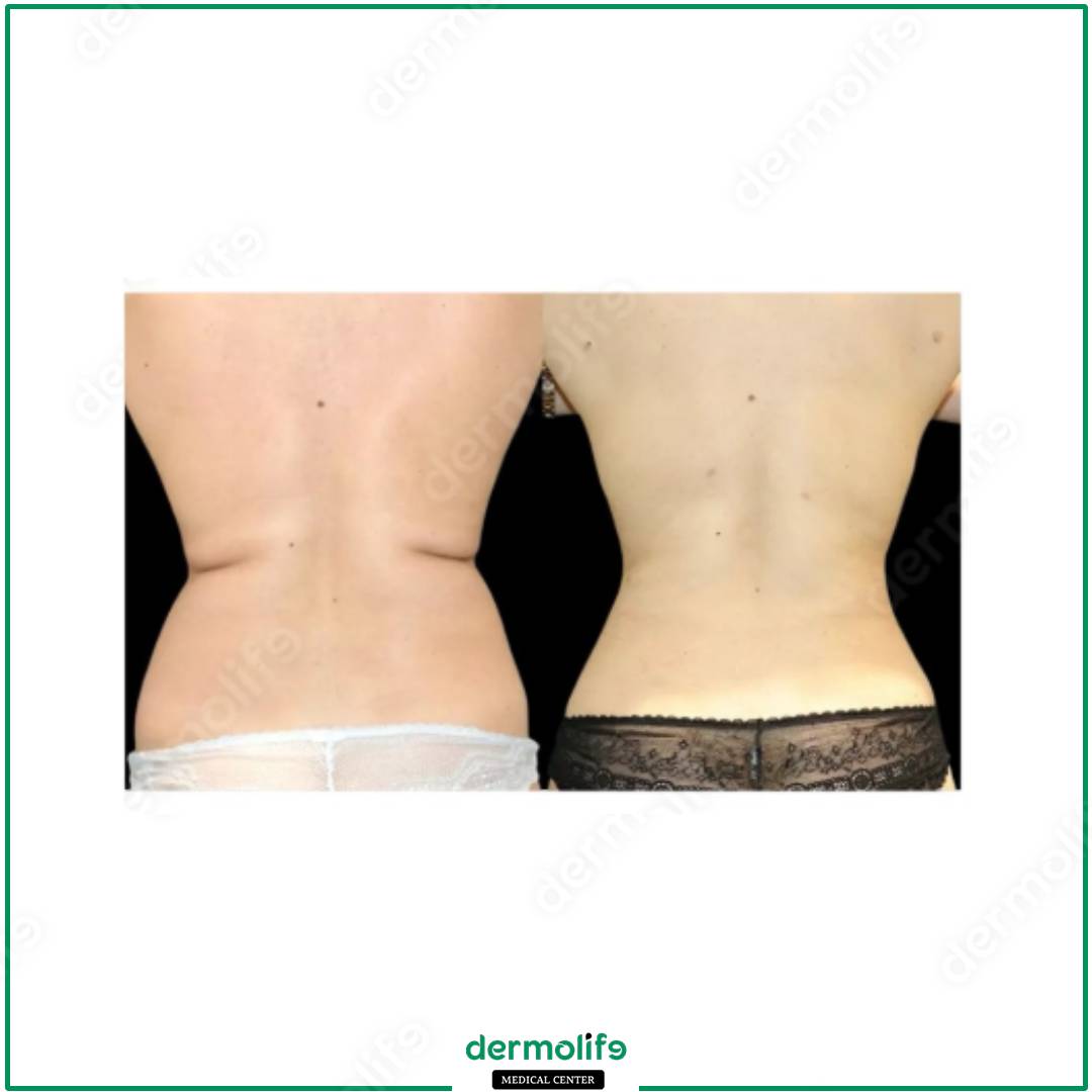 liposuction aesthetic clinic italy 