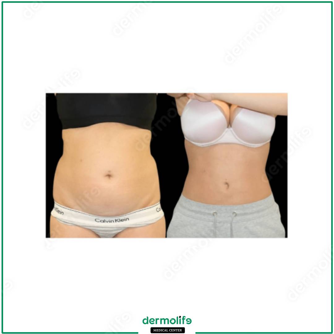 liposuction aesthetic clinic italy 