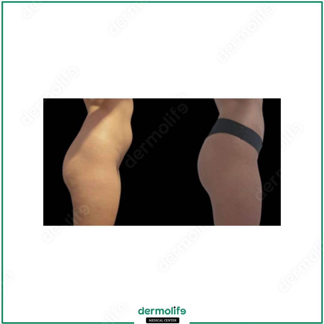 liposuction aesthetic clinic italy 