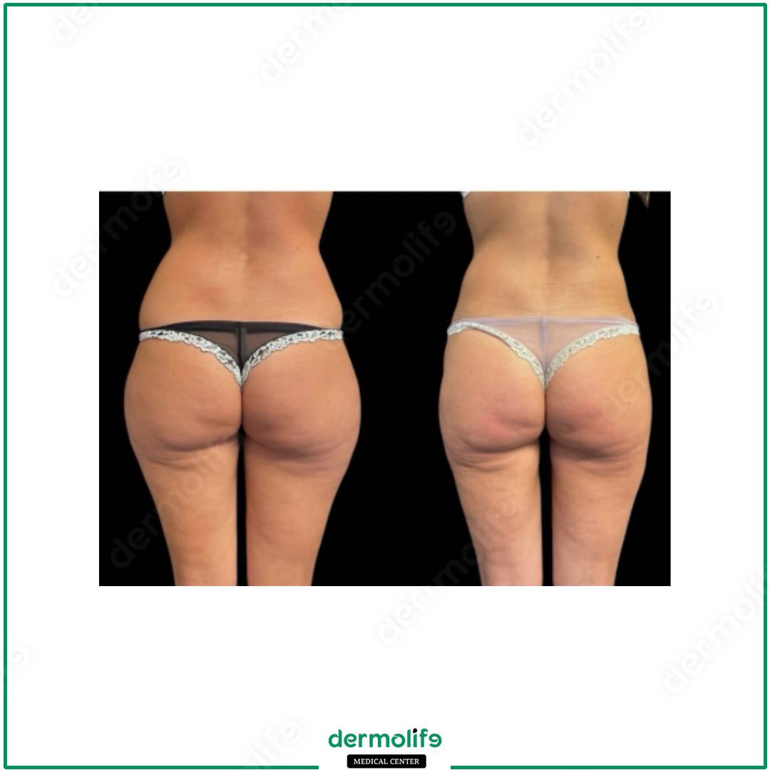 liposuction aesthetic clinic italy 