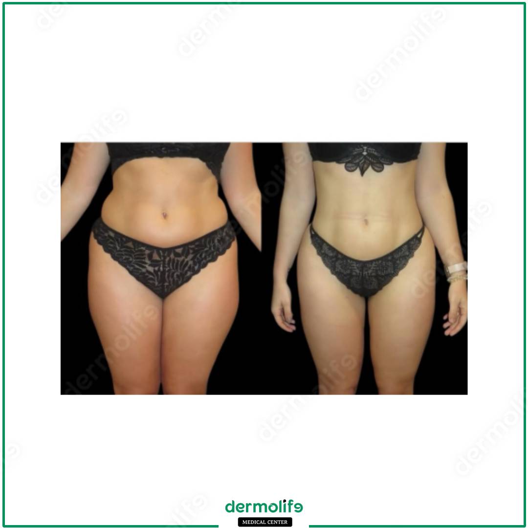 liposuction aesthetic clinic italy 