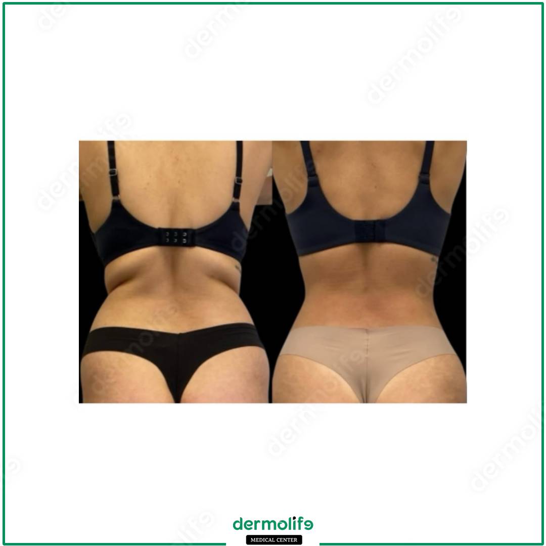 liposuction aesthetic clinic italy 