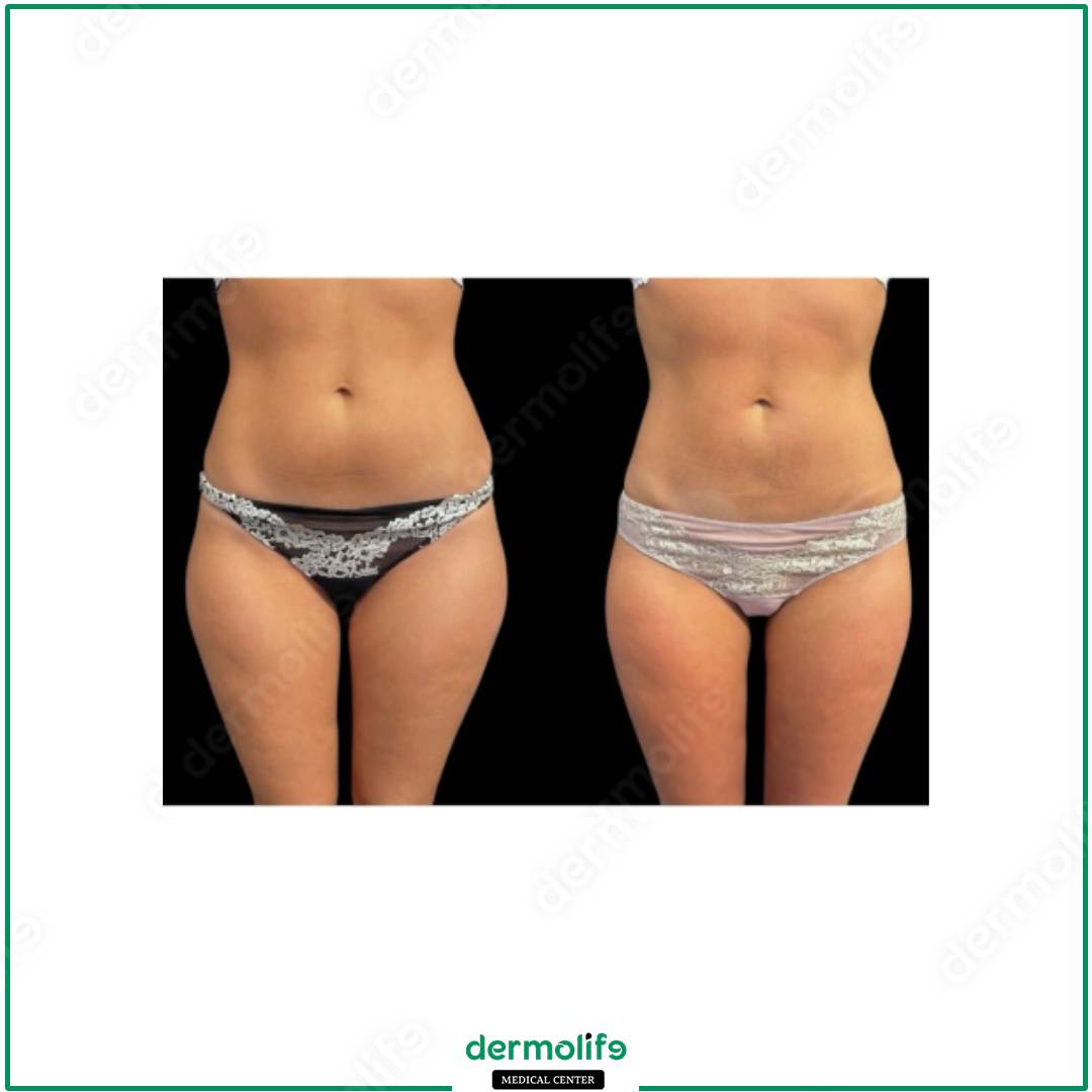 liposuction aesthetic clinic italy 