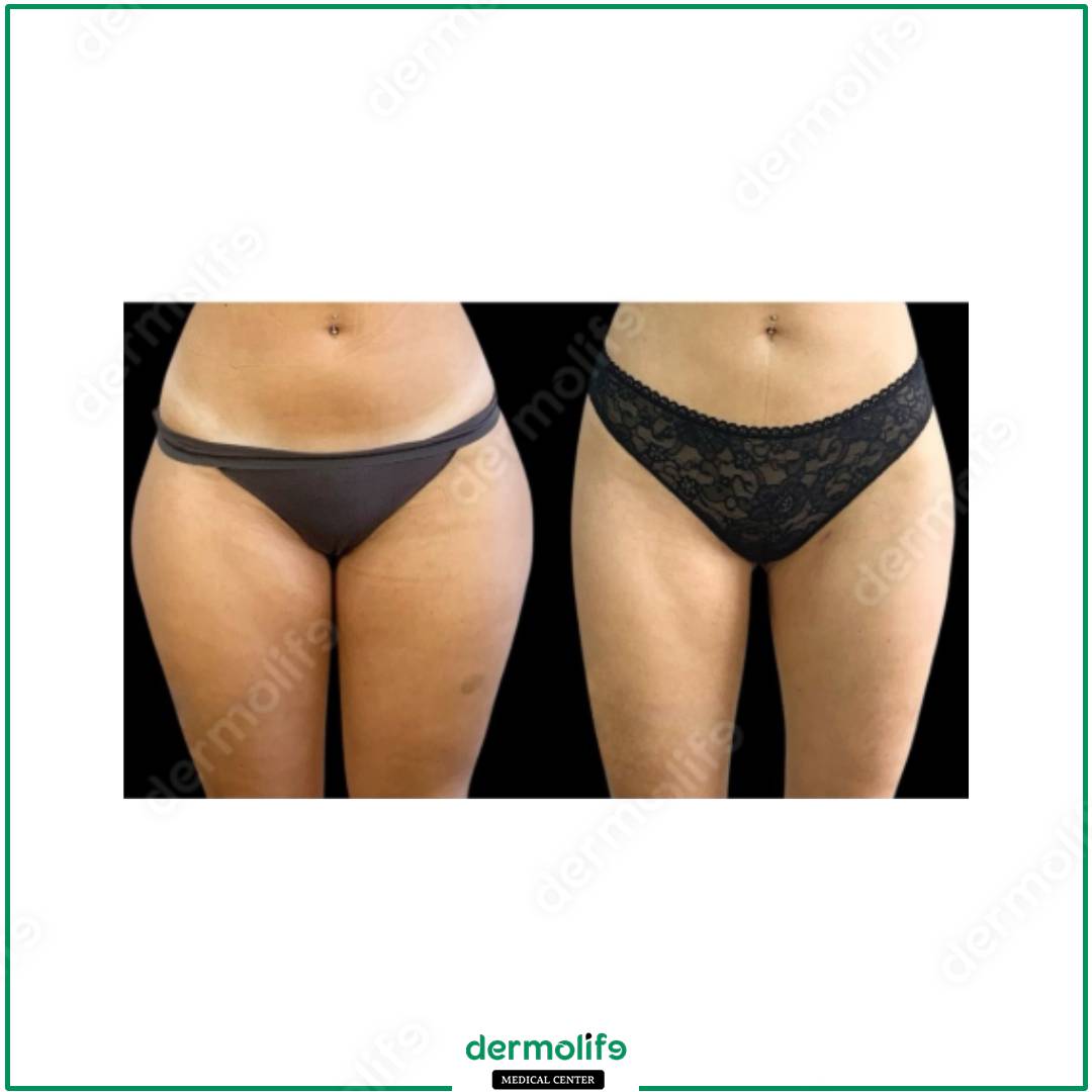liposuction aesthetic clinic italy 